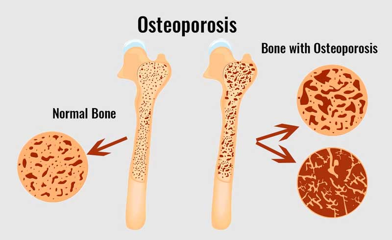 Don’t Let Brittle Bones Shatter Your Life – Matt Faller Insurance Idaho